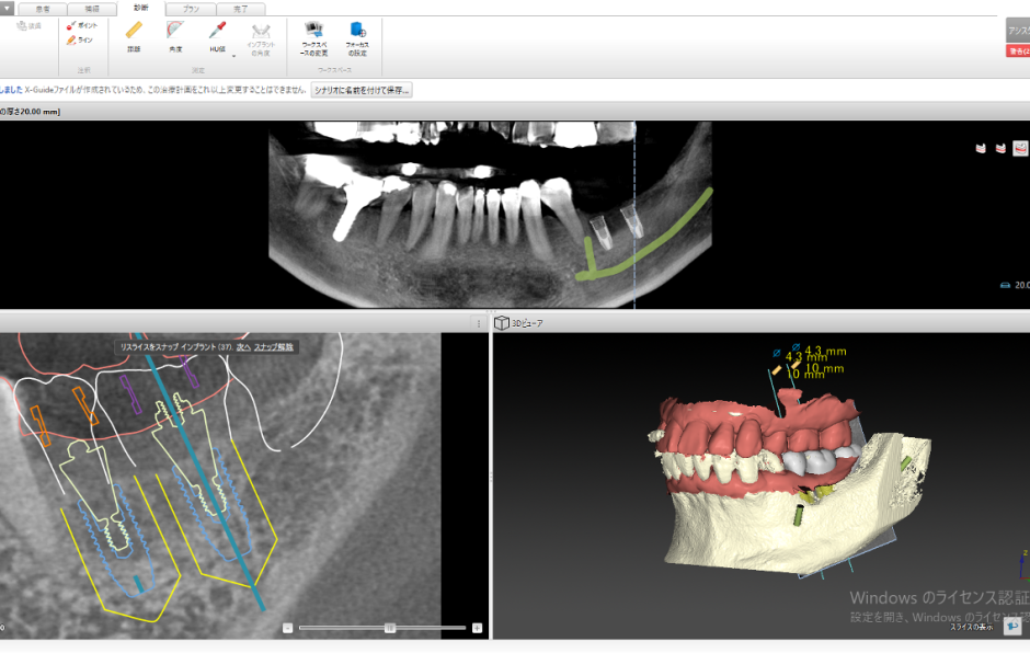 DTX_Studio_Implant