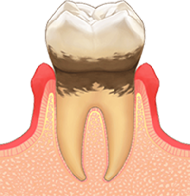 軽度歯周病@2x
